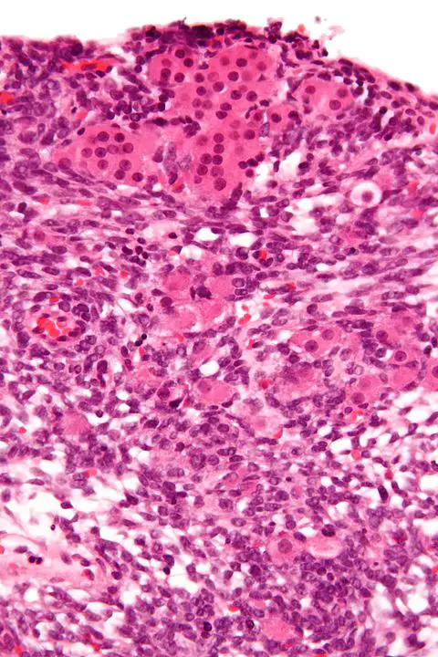 Very high magnification micrograph of a Sertoli-Leydig cell tumour, H&E stain by Nephron - Own work, CC BY-SA 3.0, https://commons.wikimedia.org/w/index.php?curid=16945455
