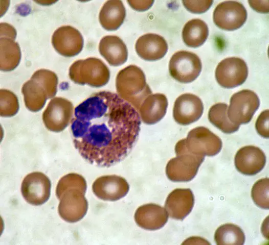 Eosinophil blood smear by Bobjgalindo - Own work, CC BY-SA 4.0, https://commons.wikimedia.org/w/index.php?curid=7761793