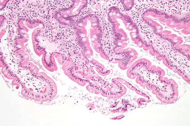 Micrograph of a small bowel mucosa (duodenum) biopsy with giardiasis. H&E stain by Nephron - Own Work, CC BY-SA 3.0, https://commons.wikimedia.org/w/index.php?curid=7306028