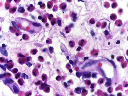 Micrograph showing high power view of Eosinophils. H&E stain,Government Medical College, Kozhikode [CC BY-SA 4.0 (https://creativecommons.org/licenses/by-sa/4.0)], via Wikimedia Commons