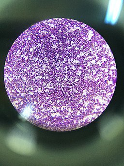 gram negative rods and gram positive cocci