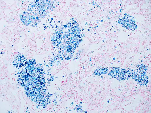 Prussian blue stain. Pulmonary veno-occlusive disease. By Yale Rosen [CC BY-SA 2.0 (http://creativecommons.org/licenses/by-sa/2.0)], via Wikimedia Commons