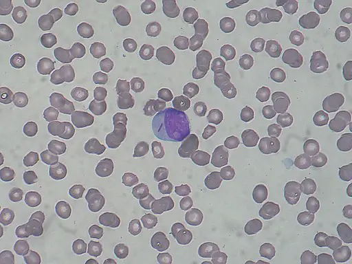 Myeloblast with Auer rod by Paulo Henrique Orlandi Mourao, CC BY-SA 3.0 <https://creativecommons.org/licenses/by-sa/3.0>, via Wikimedia Commons