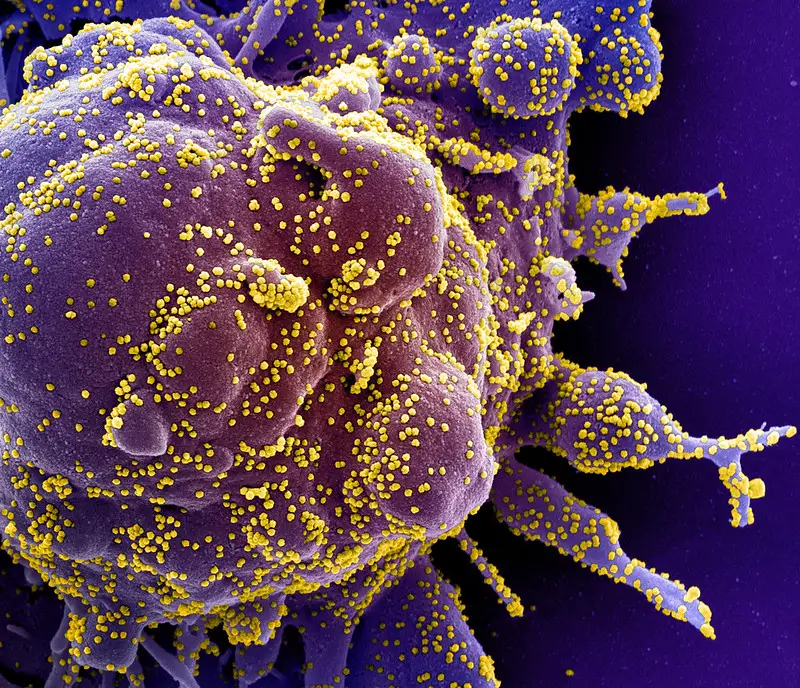 by NIAID-Novel Coronavirus SARS-CoV-2  SEM of apoptotic cell (purple) heavily infected with SARS-COV-2 virus particles (yellow),isolated from a patient sample.Flickr, public domain, unaltered.