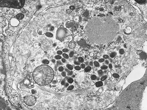 A transmission electron micrograph of a tissue section containing variola viruses. By Photo Credit: Content Providers(s): CDC/ Fred Murphy; Sylvia Whitfield [Public domain], via Wikimedia Commons