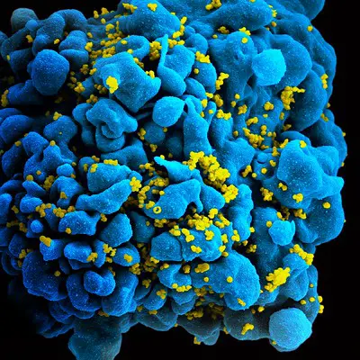 HIV-infected T cell  Scanning electromicrograph of an HIV-infected T cell. Credit: NIAID, https://creativecommons.org/licenses/by/2.0/ on Flickr.com