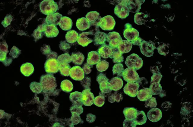 Histopathology of amebic meningoencephalitis d/t Naegleria fowleri. Direct fluorescent antibody stain: CDC/ Dr. Govinda S. Visvesvara,Public Domain