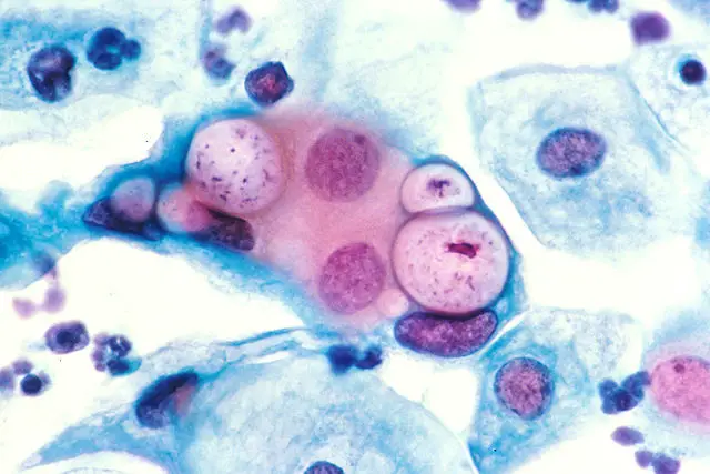 Human pap smear showing clamydia in the vacuoles at 500x and stained with H&E. Source: Dr. Lance Liotta Laboratory. Public Domain.