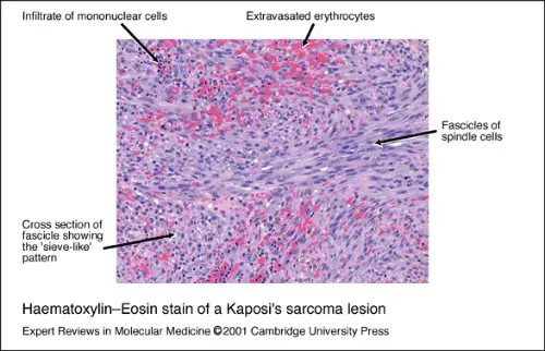 Haematoxylin-Eosin Stain Kaposi's Sarcoma lesion