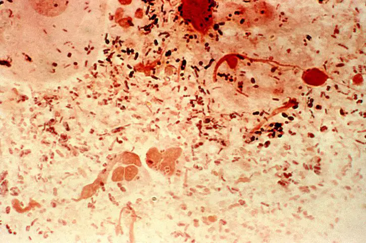 Gonorrhea Neisseria gonorrhoeae by Joe Miller, USCDCP, public domain.
