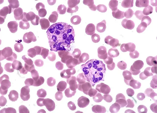 By Ed Uthman:Hypersegmented Neutrophils  Peripheral blood film in 40ish pancytopenic patient who has been treated for ovarian cancer by chemotherapy. https://www.flickr.com/photos/euthman/36831145373