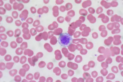 Giant Platelet, Peripheral Blood Smear by Ed Uthman at Flickr.com, https://creativecommons.org/licenses/by/2.0/